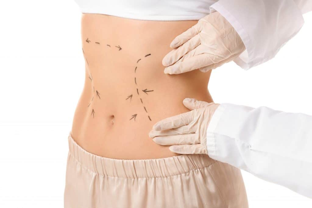 A woman is having plastic surgery on her stomach in Tijuana.