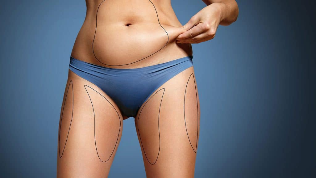 A woman in a bikini showcasing her flat stomach after plastic surgery in Tijuana.