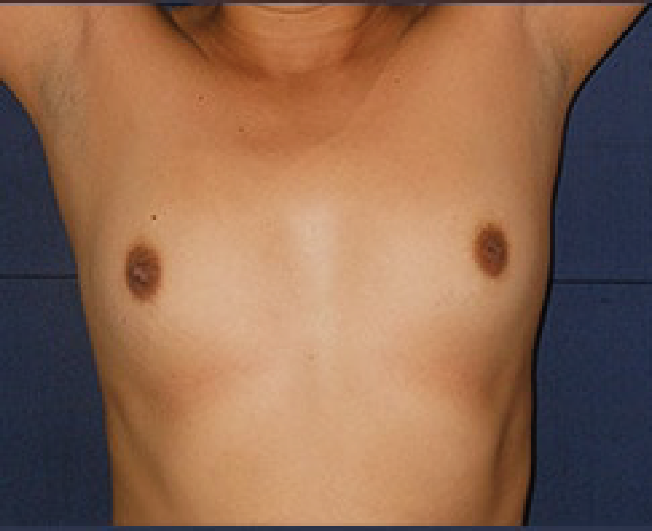 A woman's breast before and after breast augmentation in Tijuana.