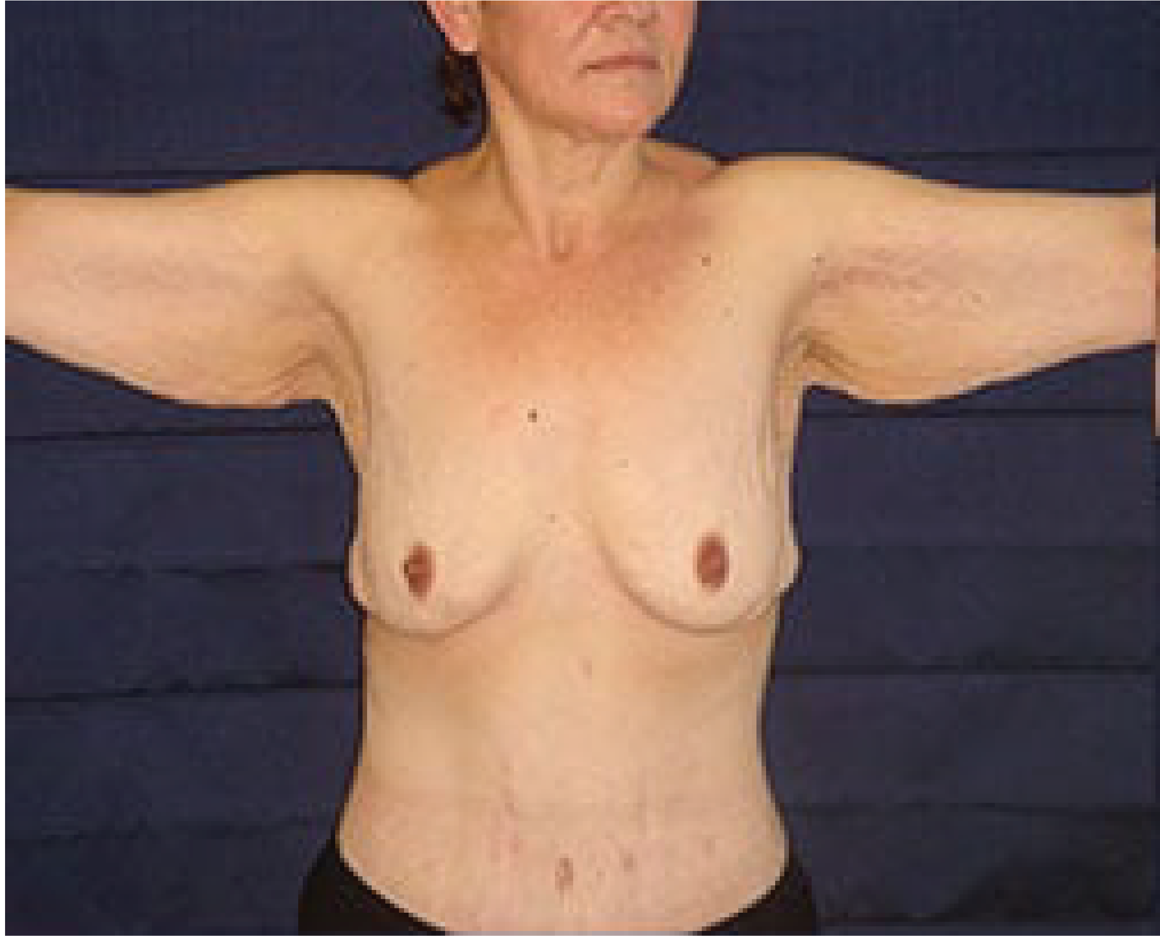 A woman's breast before and after plastic surgery in Tijuana.