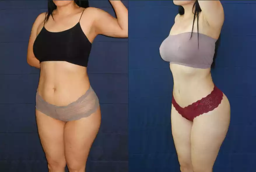 Before and after comparison of a woman showing body transformation. The left image shows the woman wearing a black crop top and gray underwear, and the right image shows her wearing a gray bandeau and red underwear.