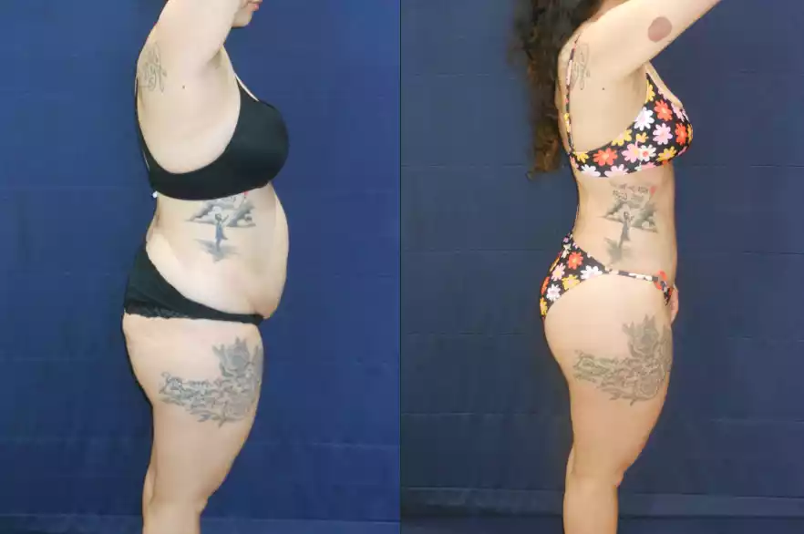 Side-by-side comparison of a woman's body before (left) and after (right) weight loss, showing a significant reduction in abdominal size and change in overall body shape.