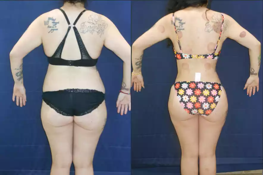 Before and after images of a woman in underwear, showing back tattoos, with her arms raised slightly. The before image on the left shows more body fat compared to the after image on the right.