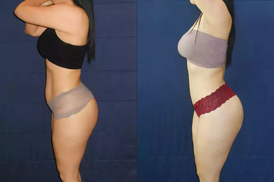 Side-by-side images of a woman showcasing a physical transformation, with the left image showing the "before" state and the right image the "after" state.