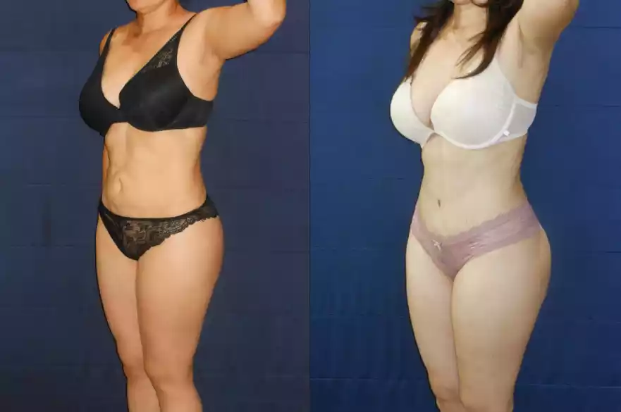 Side-by-side comparison of a woman before and after body transformation, wearing black underwear in the first image on the left and light-colored underwear in the second image on the right.