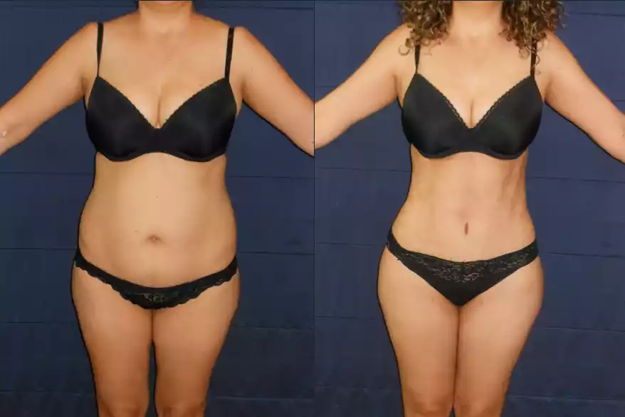 Side-by-side images of a woman before and after weight loss, wearing black underwear. The "before" image shows a fuller figure, and the "after" image shows a slimmer, more toned body.