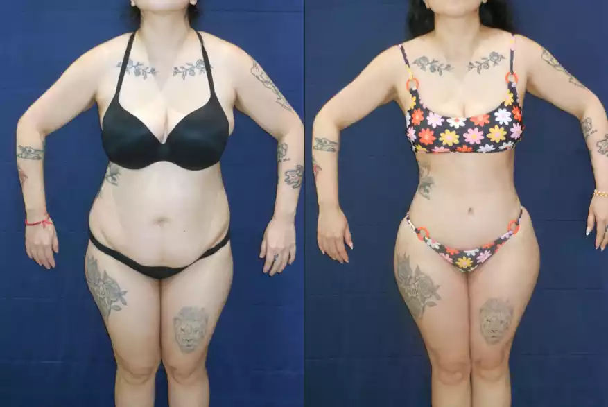 Side-by-side comparison of a woman before (left) and after (right) undergoing a body transformation, both in minimal clothing, highlighting changes in body shape and appearance.