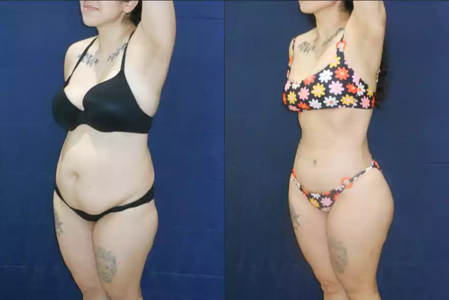 Side-by-side comparison of a person before and after showing weight loss, wearing a black bra and panties in the left image and a floral bikini in the right image, against a dark blue background.