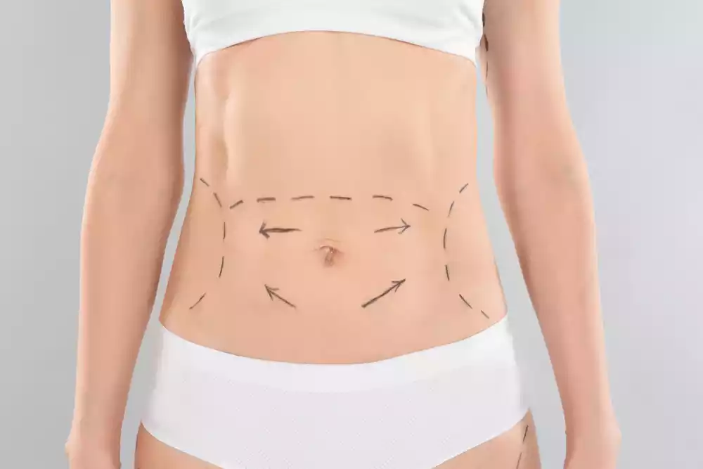 tummy tuck results