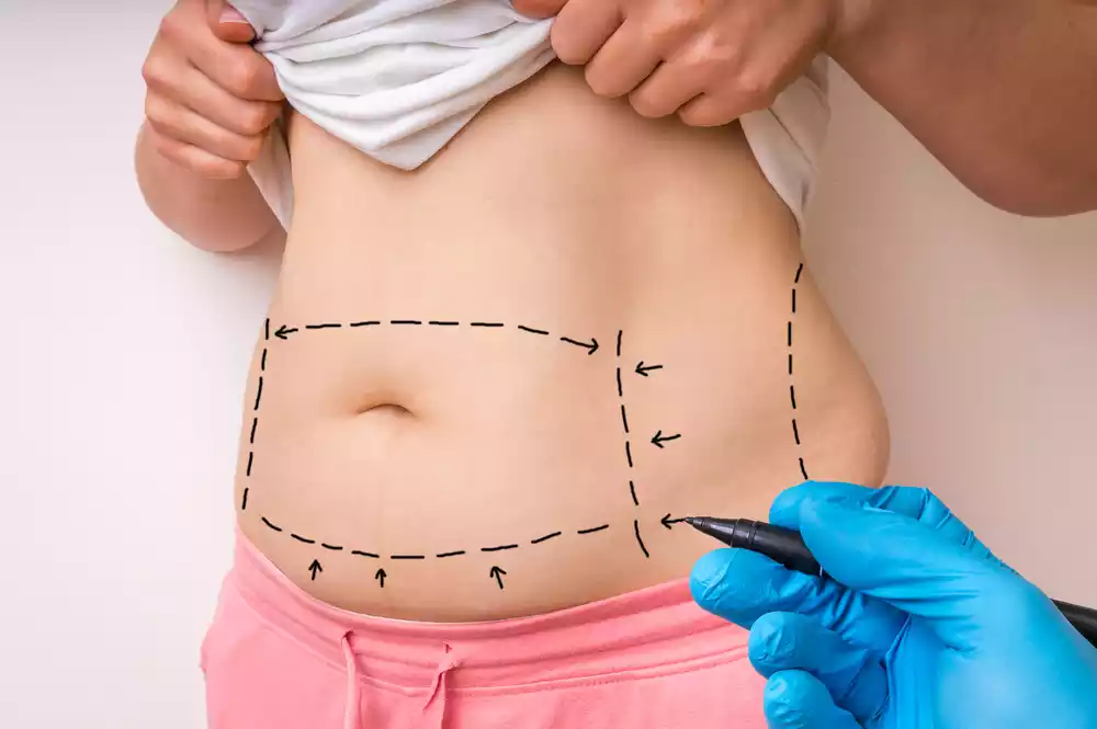 liposuction candidates