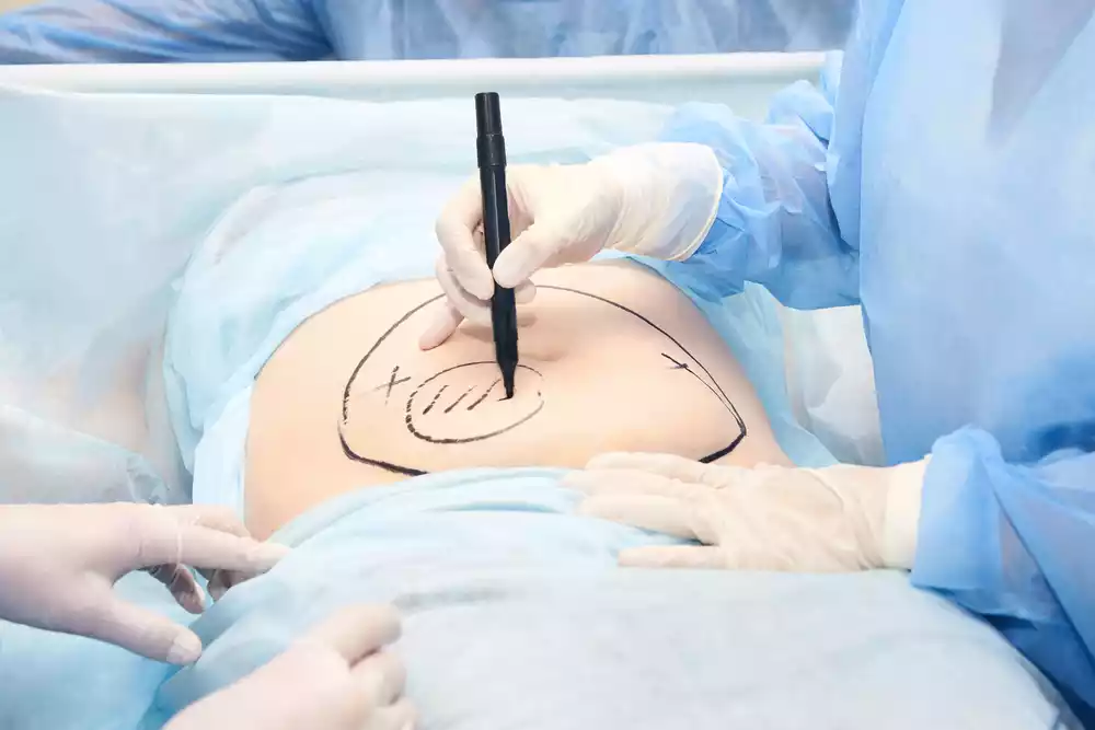 tummy tuck scar care