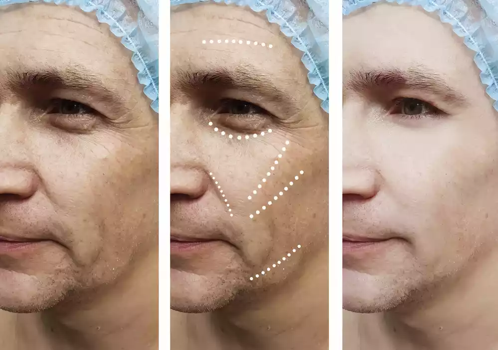 Triptych showing a person's face before, during, and after a cosmetic procedure, marked with dotted lines to indicate areas targeted for treatment.
