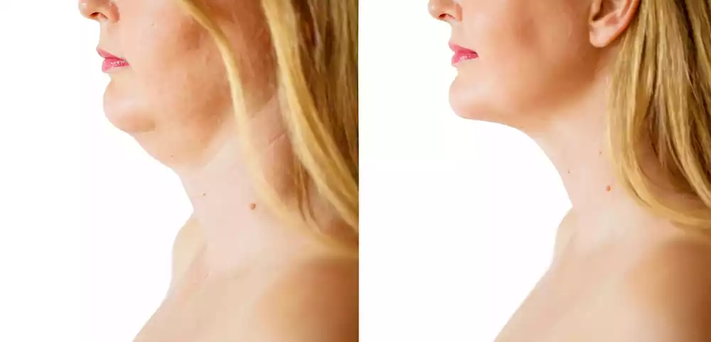 Before and after side profile images showing reduction of double chin.