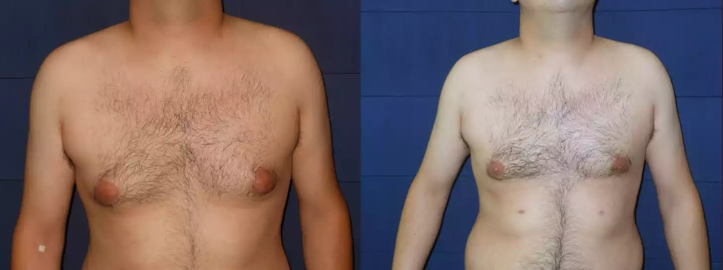Before and after photo of a shirtless person standing against a blue background, showing a noticeable reduction in chest size.