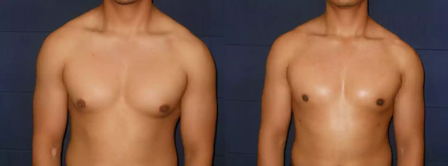 Before and after image showing a person's torso, with the before image on the left depicting a more prominent chest and the after image on the right showing a reduced chest size.