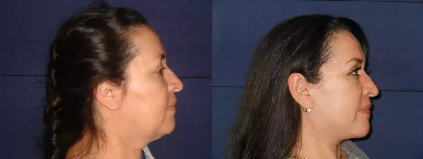 Profile view of a woman before (left) and after (right) a procedure, showing a visible difference in her facial and neck appearance.