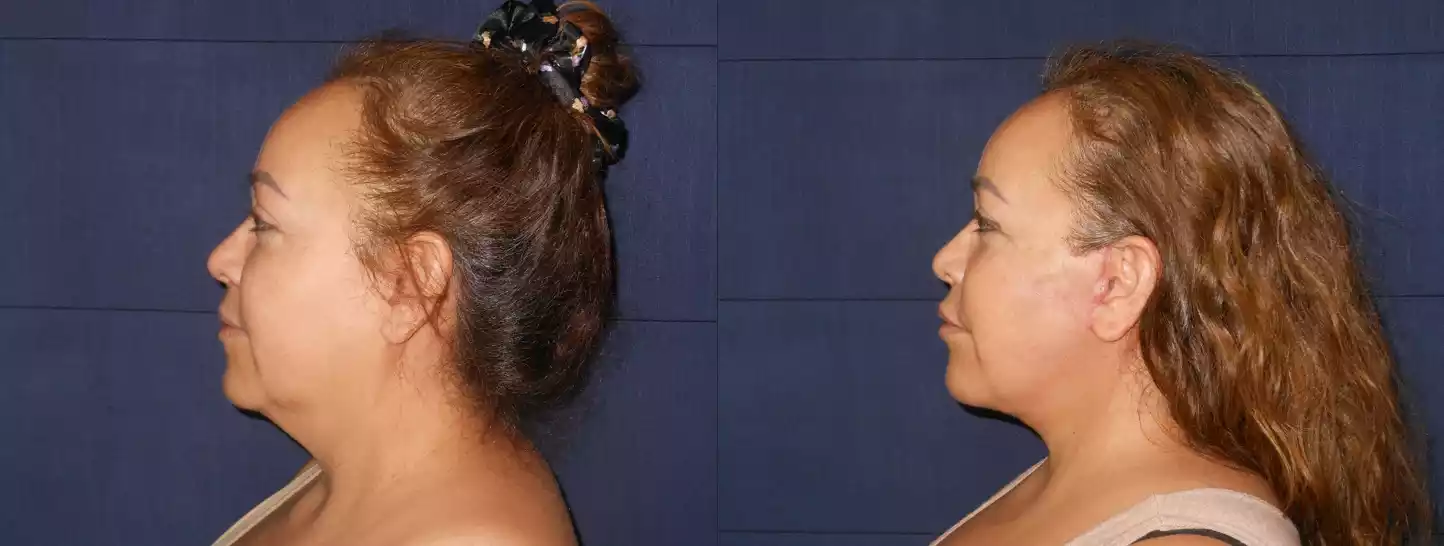 Side-by-side profile comparison of a woman before (left) and after (right) a cosmetic procedure, highlighting changes in the jawline and neck area.