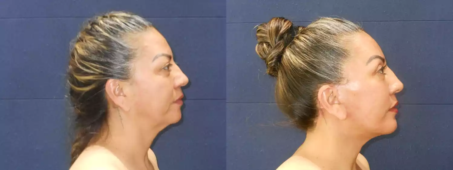 Side-by-side comparison of a woman's profile before and after a cosmetic procedure, showing noticeable improvement in skin tightness and contour.