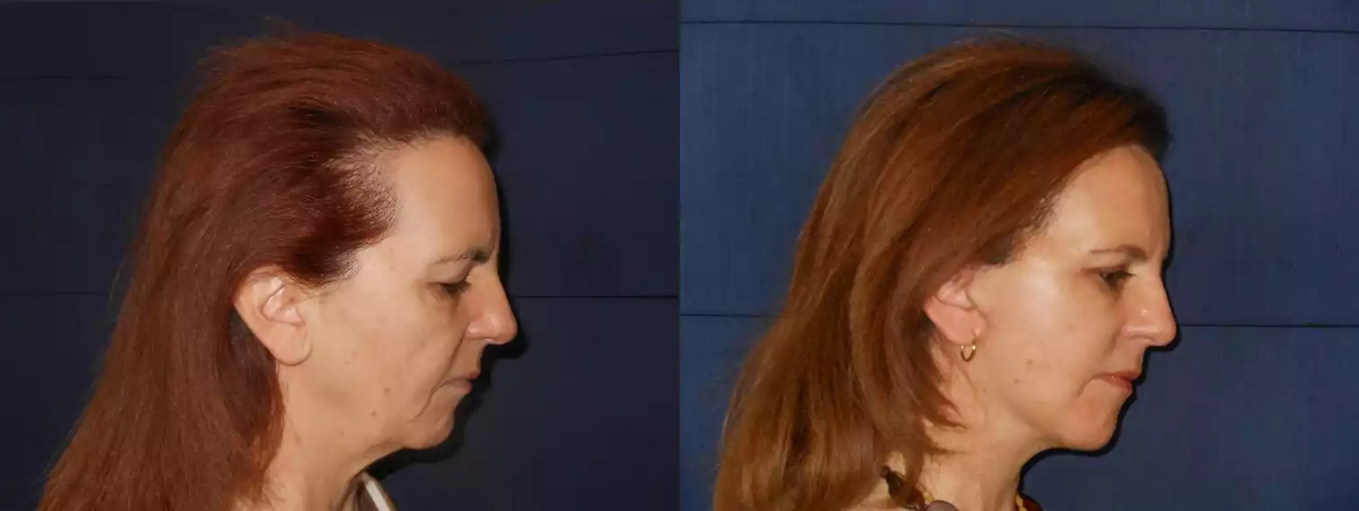 Side-by-side profile images of a woman before and after a cosmetic procedure, showing subtle improvements in skin smoothness and hair texture.