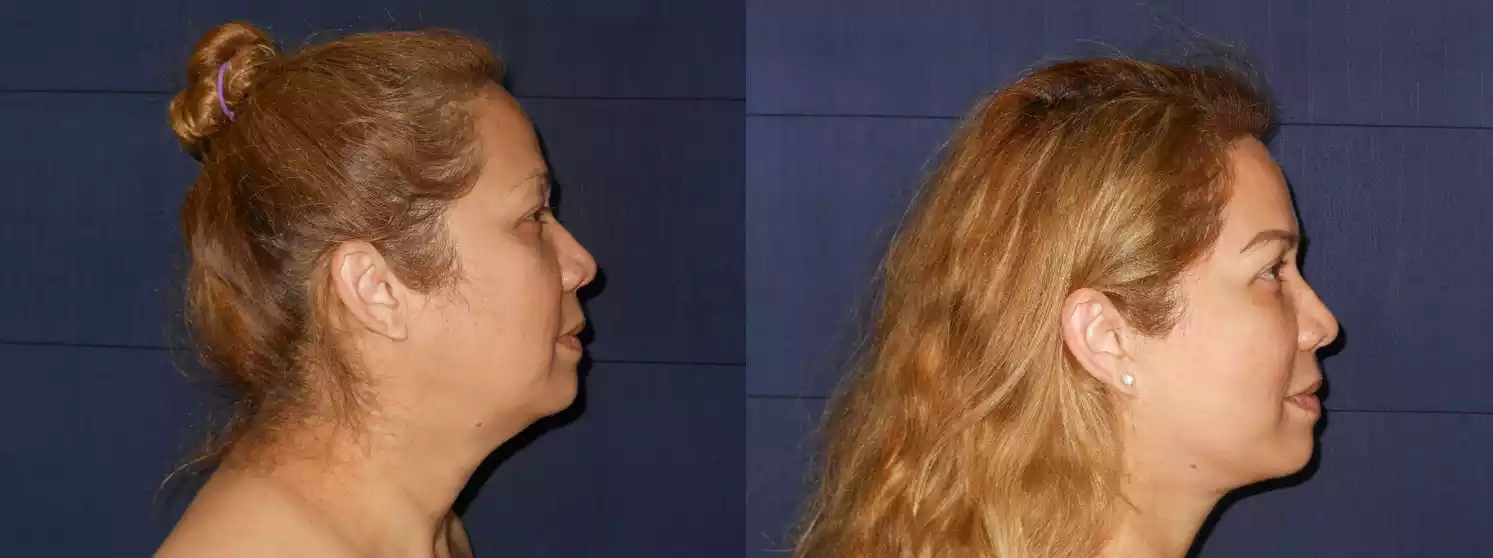 Side-by-side comparison of a woman before and after a cosmetic procedure showing a noticeable change in the profile, particularly in the jawline and neck area.