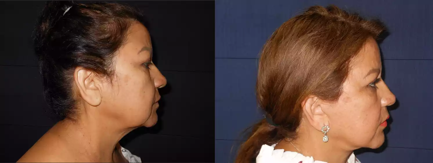 Side-by-side comparison showing a woman's profile before (left) and after (right) cosmetic surgery, highlighting changes in the jawline, neck, and overall facial contour.