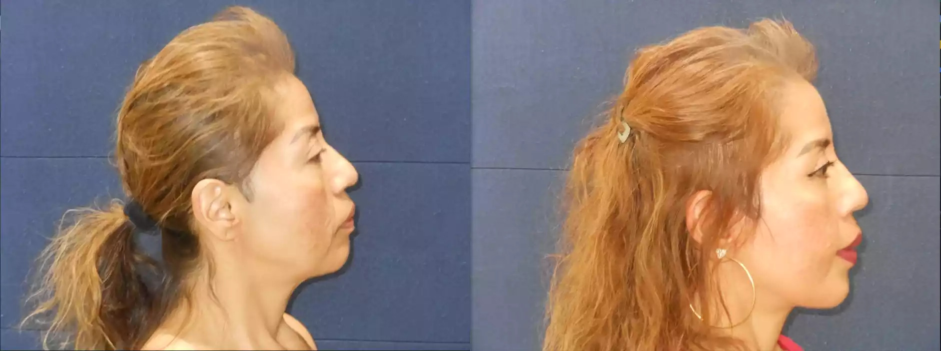 Side-by-side profile views of a person before (left) and after (right) undergoing a cosmetic or medical treatment showing changes in facial features.
