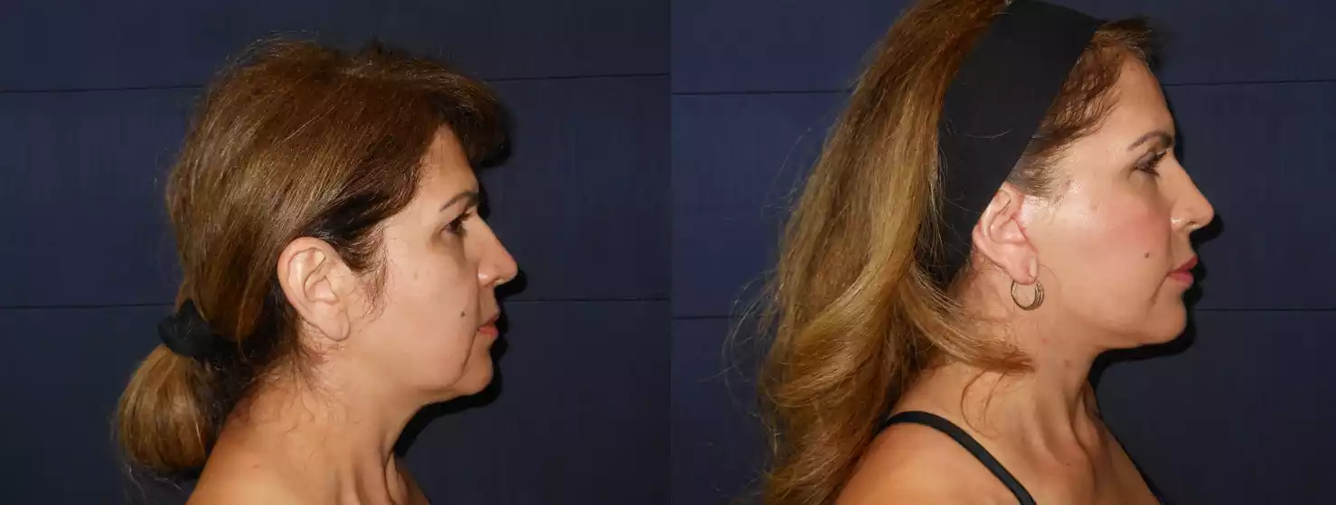 Side-by-side profile photos of a woman before and after a cosmetic procedure, showing changes in her jawline and neck area.