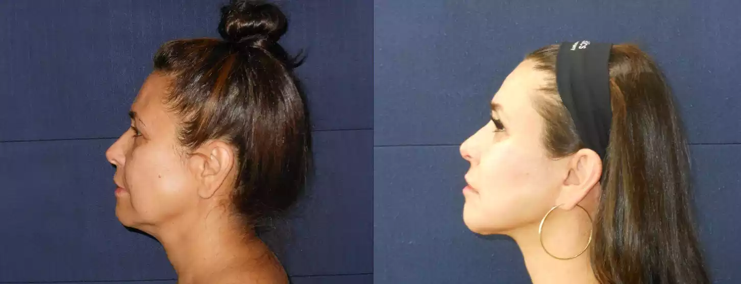 Side profile comparison of a woman before and after a cosmetic procedure, with noticeable improvements in jawline and neck area.