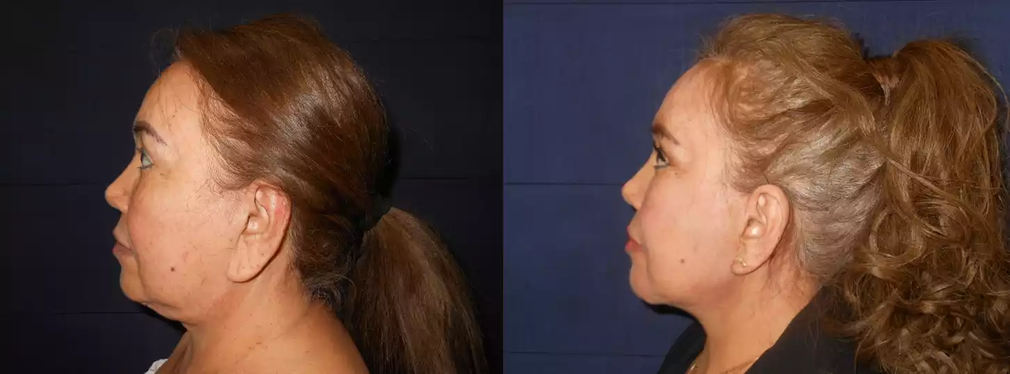 Side-by-side profile images of a person before and after a cosmetic procedure, showing significant reduction in sagging skin around the neck and jawline.