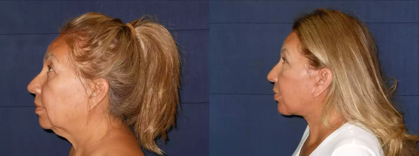 Side-by-side profile views of the same woman showing before (left) and after (right) a cosmetic procedure, evident by changes in facial appearance and skin tone.