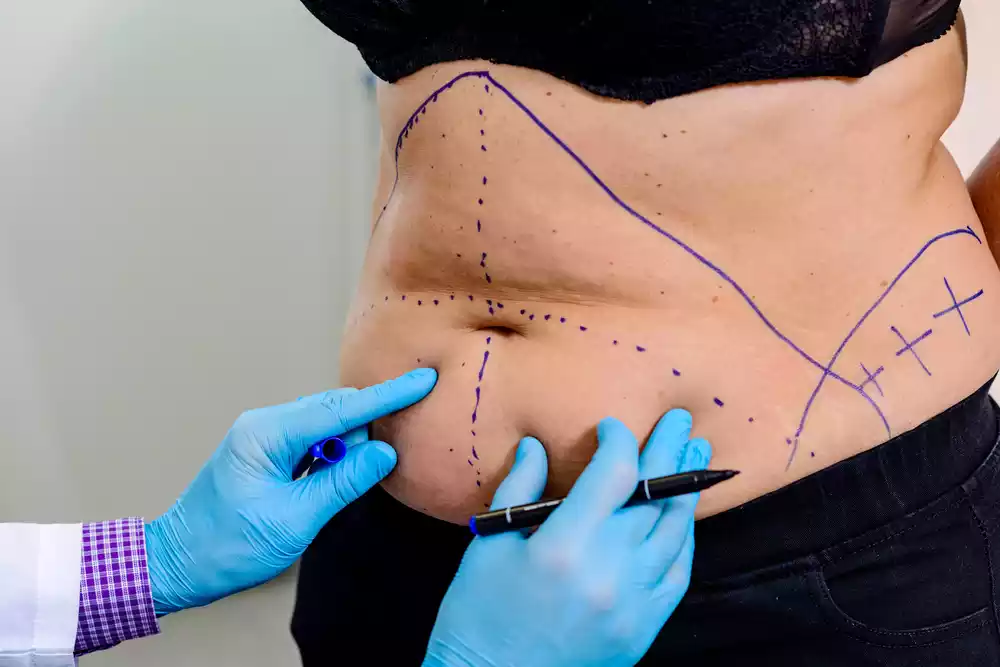 Tummy Tuck Consultation