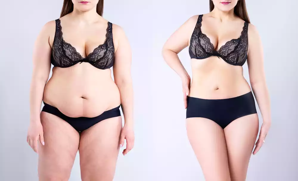 Tummy Tuck b and A