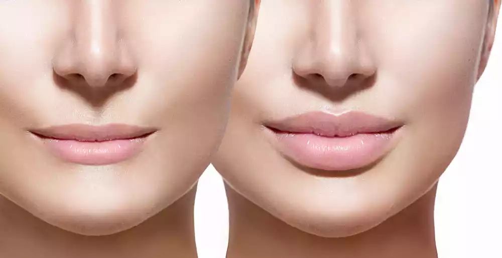lip fillers trend