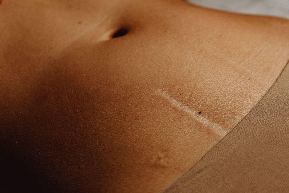 plastic surgery scar care